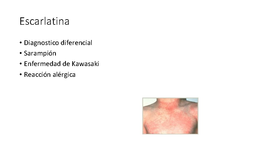 Escarlatina • Diagnostico diferencial • Sarampión • Enfermedad de Kawasaki • Reacción alérgica 