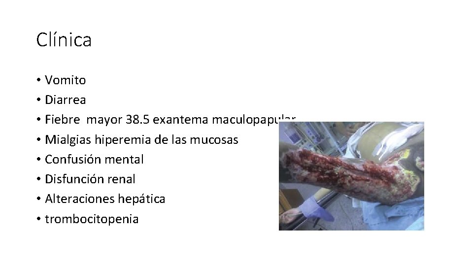 Clínica • Vomito • Diarrea • Fiebre mayor 38. 5 exantema maculopapular • Mialgias Clínica • Vomito • Diarrea • Fiebre mayor 38. 5 exantema maculopapular • Mialgias