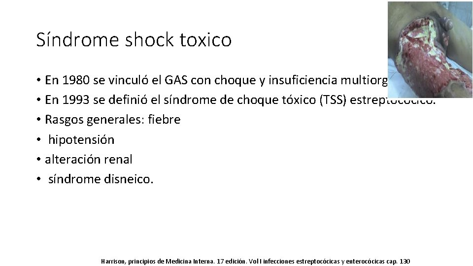 Síndrome shock toxico • En 1980 se vinculó el GAS con choque y insuficiencia