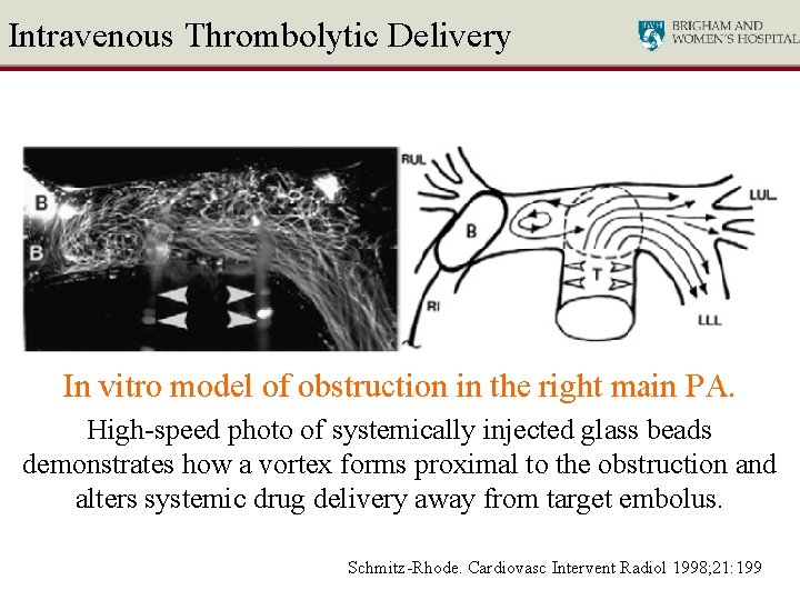 Intravenous Thrombolytic Delivery In vitro model of obstruction in the right main PA. High-speed