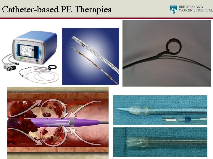 Catheter-based PE Therapies 