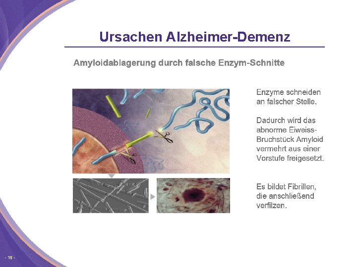 Ursachen Alzheimer-Demenz 15 