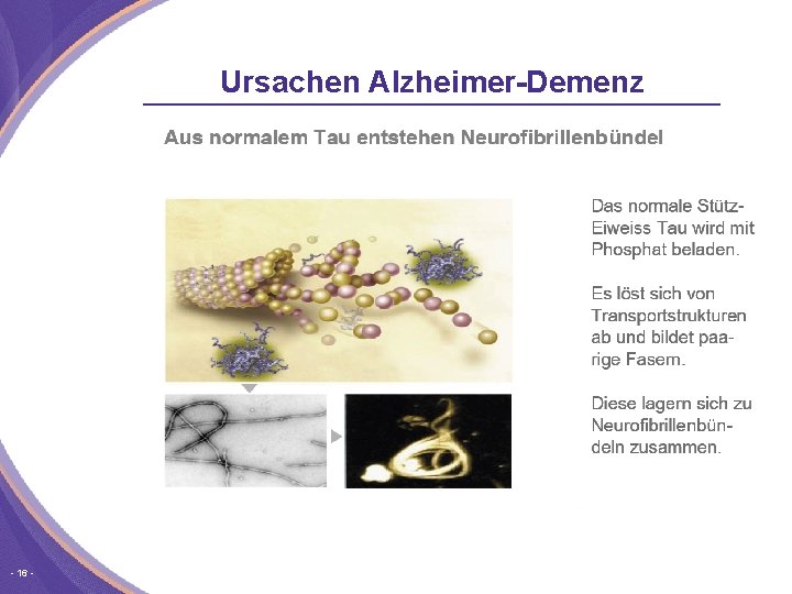 Ursachen Alzheimer-Demenz 16 