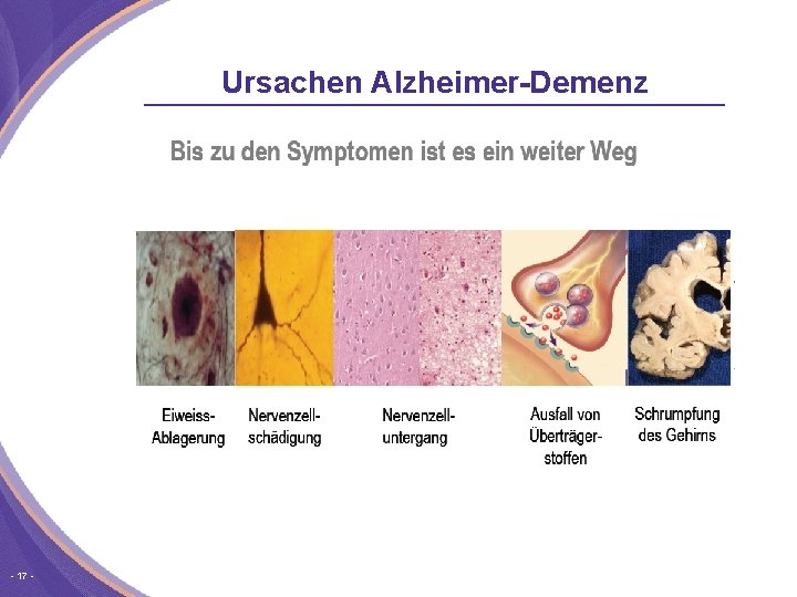 Ursachen Alzheimer-Demenz 17 