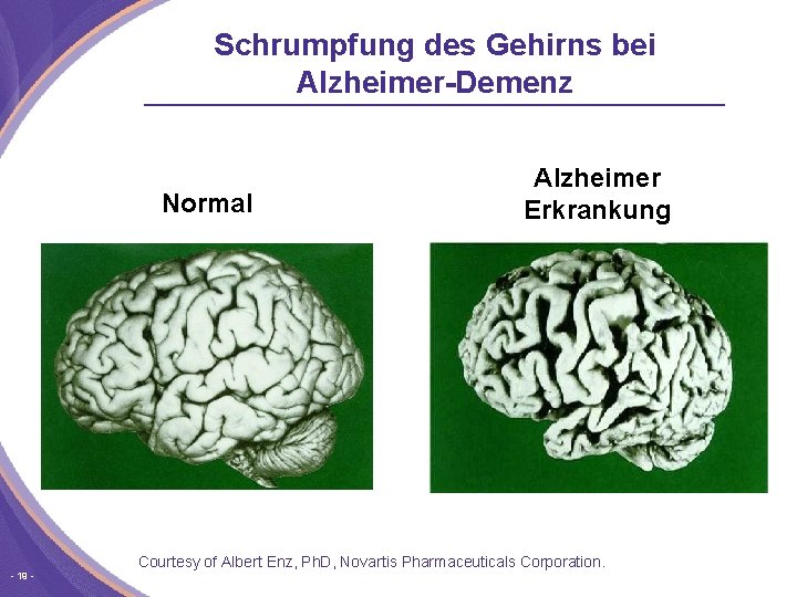 Schrumpfung des Gehirns bei Alzheimer-Demenz Normal 19 Alzheimer Erkrankung Courtesy of Albert Enz, Ph.