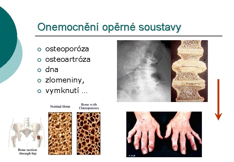 Onemocnění opěrné soustavy ¡ ¡ ¡ osteoporóza osteoartróza dna zlomeniny, vymknutí … 