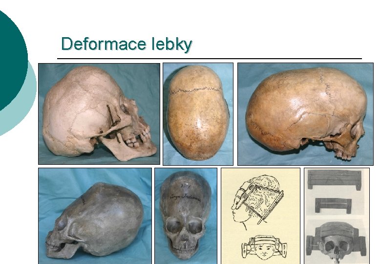 Deformace lebky 