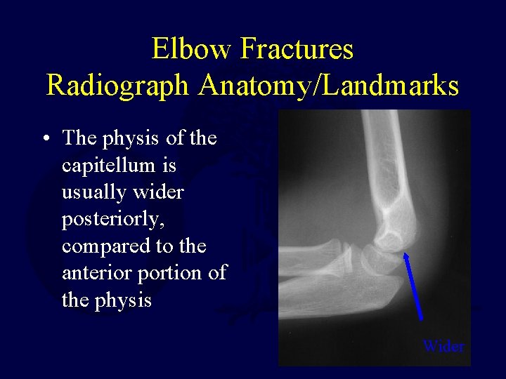 Elbow Fractures Radiograph Anatomy/Landmarks • The physis of the capitellum is usually wider posteriorly, Elbow Fractures Radiograph Anatomy/Landmarks • The physis of the capitellum is usually wider posteriorly,