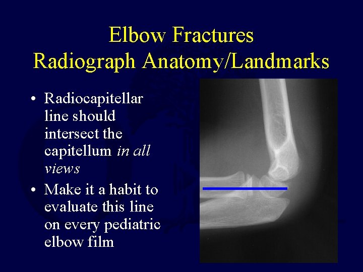 Elbow Fractures Radiograph Anatomy/Landmarks • Radiocapitellar line should intersect the capitellum in all views Elbow Fractures Radiograph Anatomy/Landmarks • Radiocapitellar line should intersect the capitellum in all views