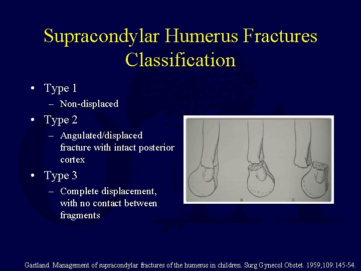 Supracondylar Humerus Fractures Classification • Type 1 – Non-displaced • Type 2 – Angulated/displaced Supracondylar Humerus Fractures Classification • Type 1 – Non-displaced • Type 2 – Angulated/displaced
