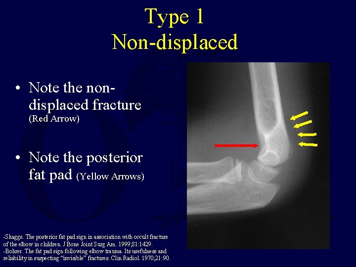 Type 1 Non-displaced • Note the nondisplaced fracture (Red Arrow) • Note the posterior Type 1 Non-displaced • Note the nondisplaced fracture (Red Arrow) • Note the posterior
