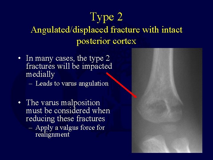 Type 2 Angulated/displaced fracture with intact posterior cortex • In many cases, the type Type 2 Angulated/displaced fracture with intact posterior cortex • In many cases, the type