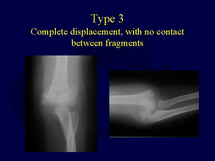 Type 3 Complete displacement, with no contact between fragments  Type 3 Complete displacement, with no contact between fragments