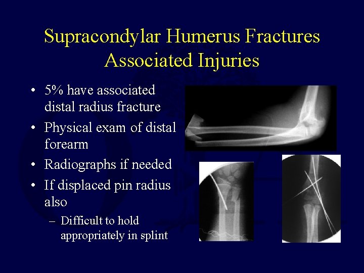 Supracondylar Humerus Fractures Associated Injuries • 5% have associated distal radius fracture • Physical Supracondylar Humerus Fractures Associated Injuries • 5% have associated distal radius fracture • Physical