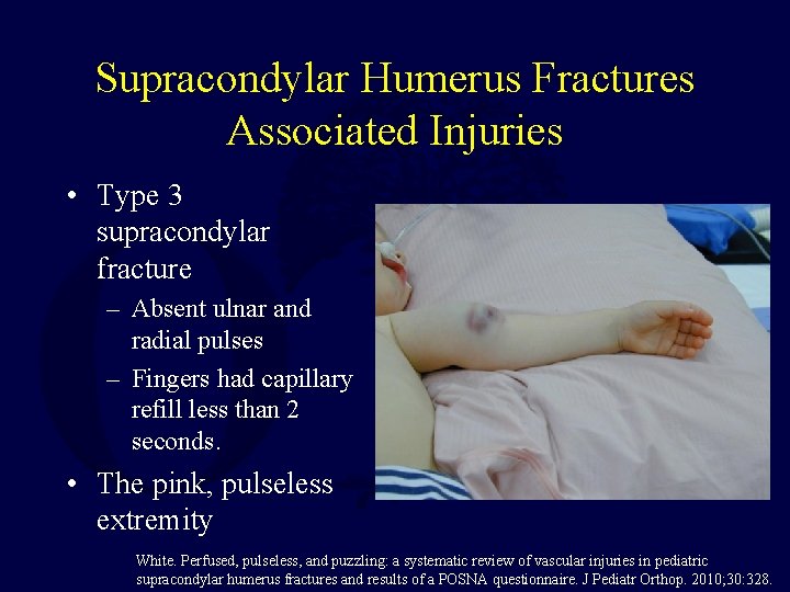 Supracondylar Humerus Fractures Associated Injuries • Type 3 supracondylar fracture – Absent ulnar and Supracondylar Humerus Fractures Associated Injuries • Type 3 supracondylar fracture – Absent ulnar and