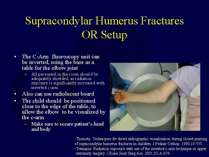 Supracondylar Humerus Fractures OR Setup • The C-Arm fluoroscopy unit can be inverted, using Supracondylar Humerus Fractures OR Setup • The C-Arm fluoroscopy unit can be inverted, using