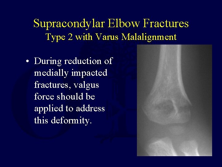 Supracondylar Elbow Fractures Type 2 with Varus Malalignment • During reduction of medially impacted Supracondylar Elbow Fractures Type 2 with Varus Malalignment • During reduction of medially impacted