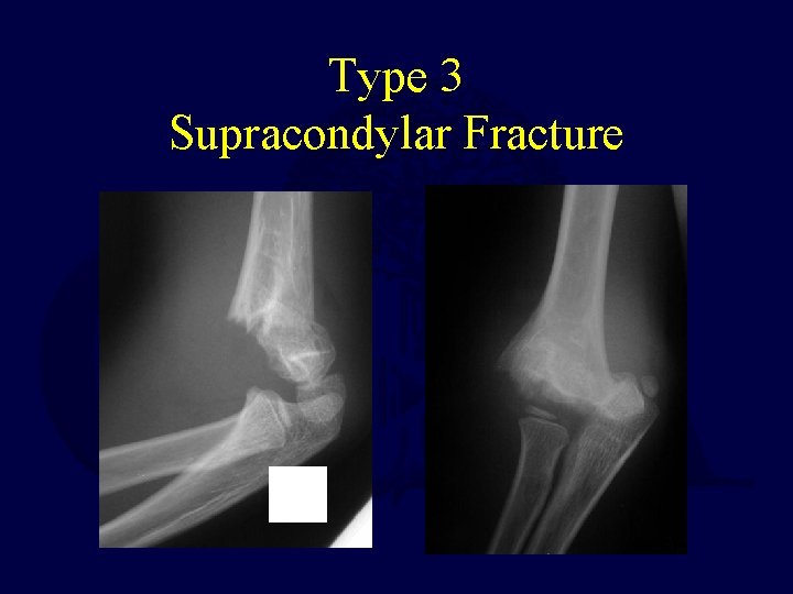 Type 3 Supracondylar Fracture  Type 3 Supracondylar Fracture