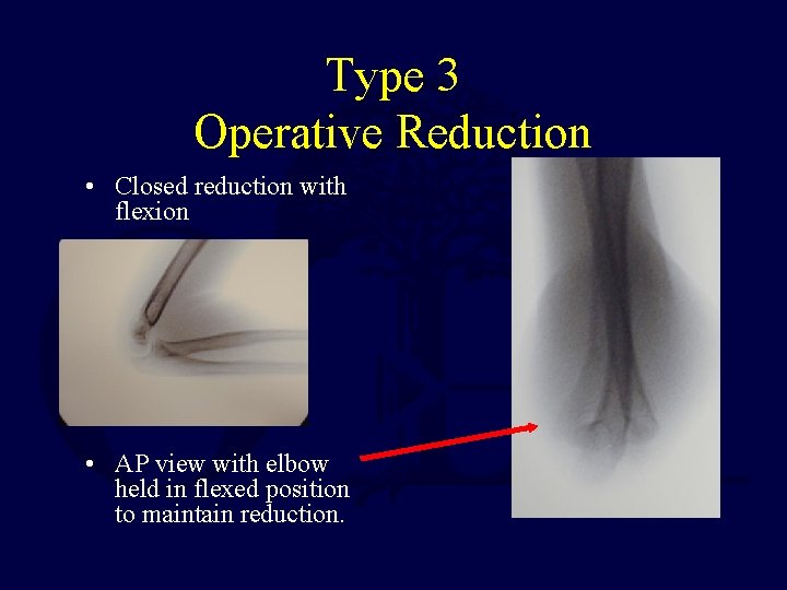 Type 3 Operative Reduction • Closed reduction with flexion • AP view with elbow Type 3 Operative Reduction • Closed reduction with flexion • AP view with elbow
