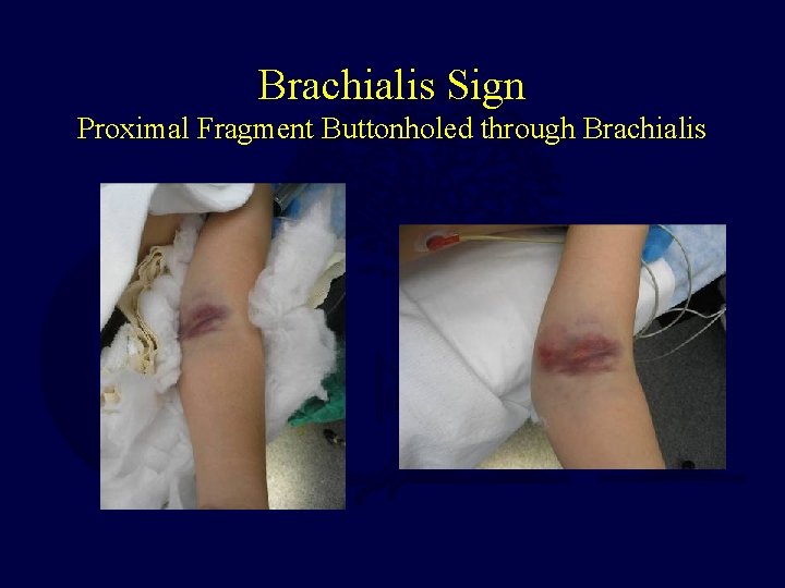 Brachialis Sign Proximal Fragment Buttonholed through Brachialis  Brachialis Sign Proximal Fragment Buttonholed through Brachialis