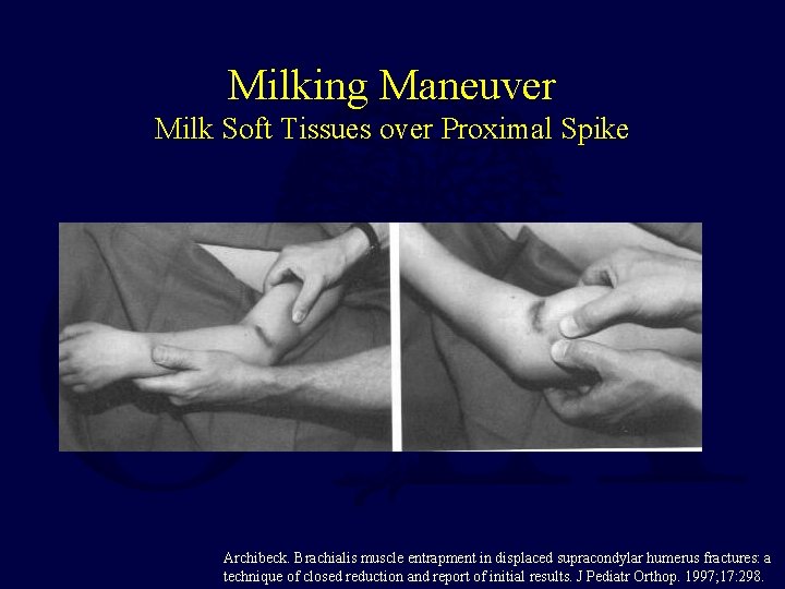Milking Maneuver Milk Soft Tissues over Proximal Spike Archibeck. Brachialis muscle entrapment in displaced Milking Maneuver Milk Soft Tissues over Proximal Spike Archibeck. Brachialis muscle entrapment in displaced