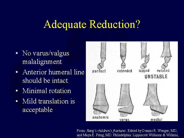Adequate Reduction? • No varus/valgus malalignment • Anterior humeral line should be intact • Adequate Reduction? • No varus/valgus malalignment • Anterior humeral line should be intact •