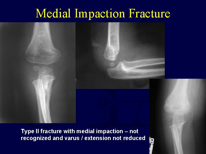 Medial Impaction Fracture Type II fracture with medial impaction – not recognized and varus Medial Impaction Fracture Type II fracture with medial impaction – not recognized and varus