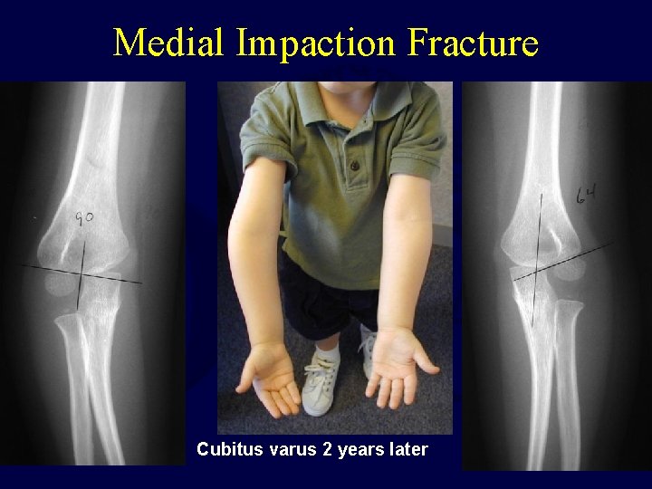 Medial Impaction Fracture Cubitus varus 2 years later  Medial Impaction Fracture Cubitus varus 2 years later
