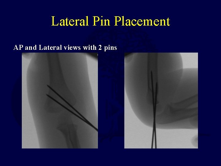 Lateral Pin Placement AP and Lateral views with 2 pins  Lateral Pin Placement AP and Lateral views with 2 pins