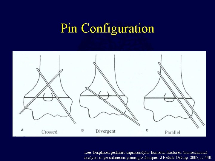 Pin Configuration Lee. Displaced pediatric supracondylar humerus fractures: biomechanical analysis of percutaneous pinning techniques. Pin Configuration Lee. Displaced pediatric supracondylar humerus fractures: biomechanical analysis of percutaneous pinning techniques.