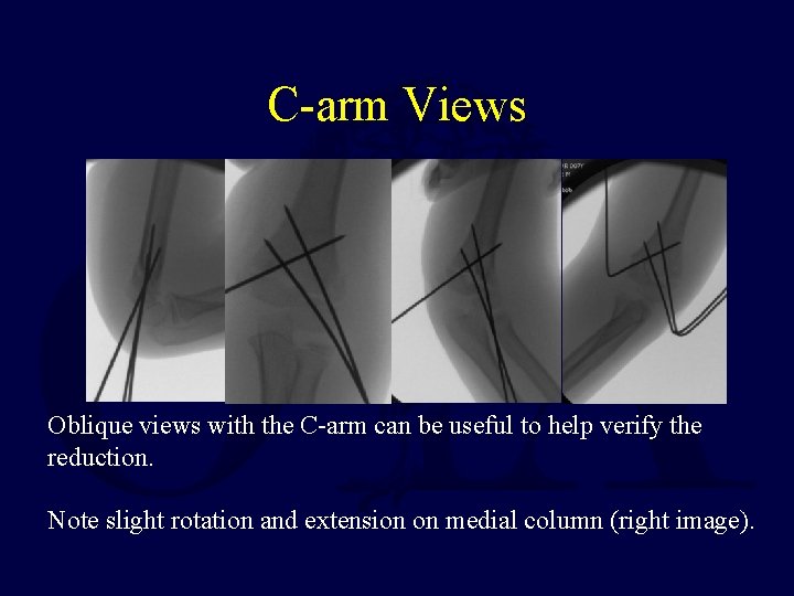 C-arm Views Oblique views with the C-arm can be useful to help verify the C-arm Views Oblique views with the C-arm can be useful to help verify the