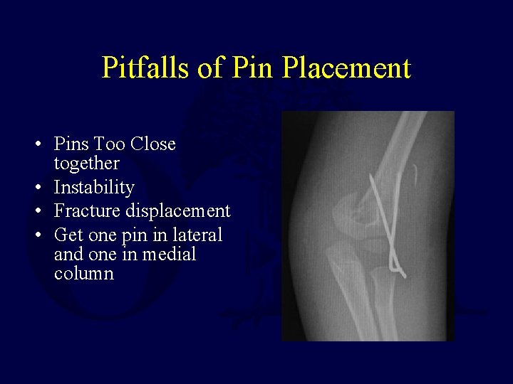 Pitfalls of Pin Placement • Pins Too Close together • Instability • Fracture displacement Pitfalls of Pin Placement • Pins Too Close together • Instability • Fracture displacement