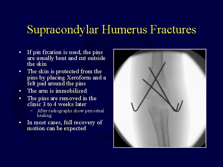 Supracondylar Humerus Fractures • If pin fixation is used, the pins are usually bent Supracondylar Humerus Fractures • If pin fixation is used, the pins are usually bent