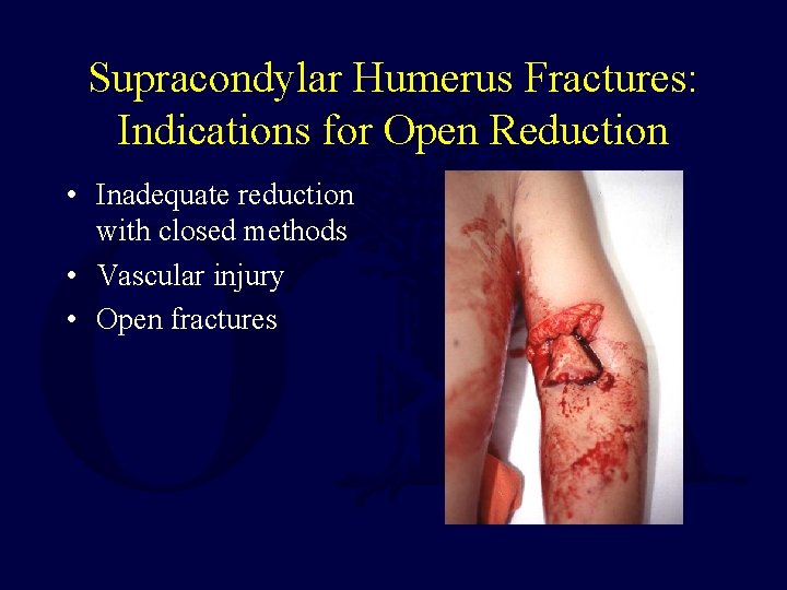 Supracondylar Humerus Fractures: Indications for Open Reduction • Inadequate reduction with closed methods • Supracondylar Humerus Fractures: Indications for Open Reduction • Inadequate reduction with closed methods •