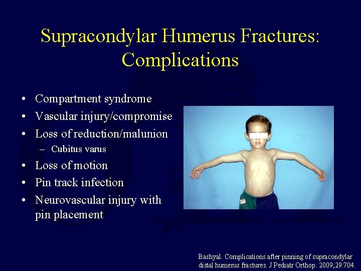 Supracondylar Humerus Fractures: Complications • Compartment syndrome • Vascular injury/compromise • Loss of reduction/malunion Supracondylar Humerus Fractures: Complications • Compartment syndrome • Vascular injury/compromise • Loss of reduction/malunion
