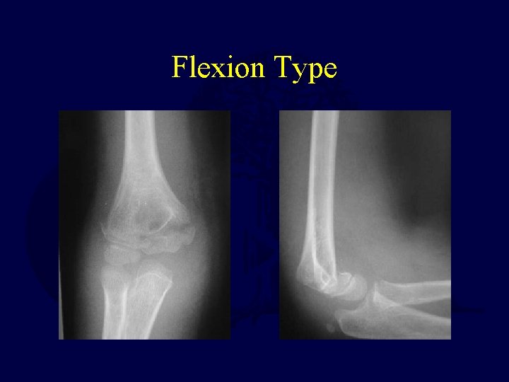 Flexion Type  Flexion Type