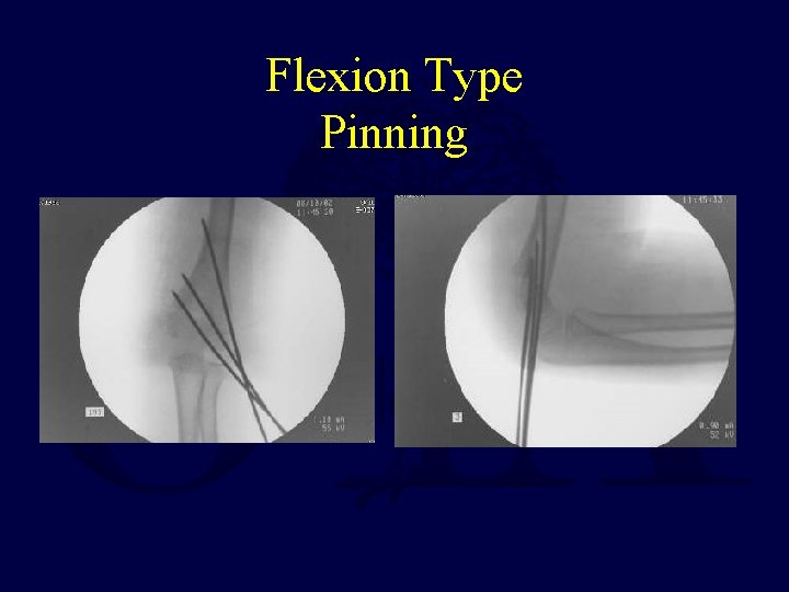Flexion Type Pinning  Flexion Type Pinning