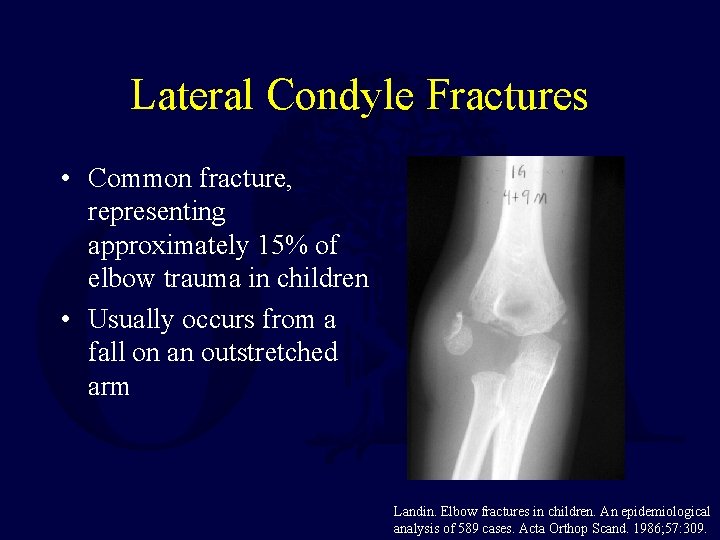 Lateral Condyle Fractures • Common fracture, representing approximately 15% of elbow trauma in children Lateral Condyle Fractures • Common fracture, representing approximately 15% of elbow trauma in children