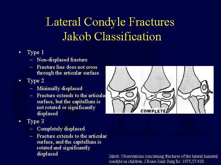 Lateral Condyle Fractures Jakob Classification • Type 1 – Non-displaced fracture – Fracture line Lateral Condyle Fractures Jakob Classification • Type 1 – Non-displaced fracture – Fracture line