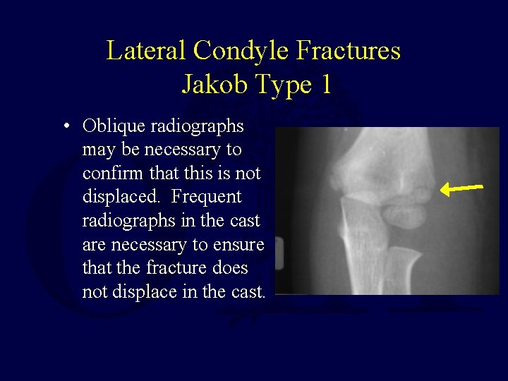Lateral Condyle Fractures Jakob Type 1 • Oblique radiographs may be necessary to confirm Lateral Condyle Fractures Jakob Type 1 • Oblique radiographs may be necessary to confirm