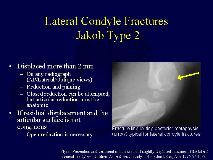 Lateral Condyle Fractures Jakob Type 2 • Displaced more than 2 mm – On Lateral Condyle Fractures Jakob Type 2 • Displaced more than 2 mm – On