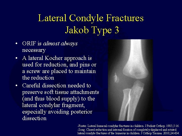 Lateral Condyle Fractures Jakob Type 3 • ORIF is almost always necessary • A Lateral Condyle Fractures Jakob Type 3 • ORIF is almost always necessary • A