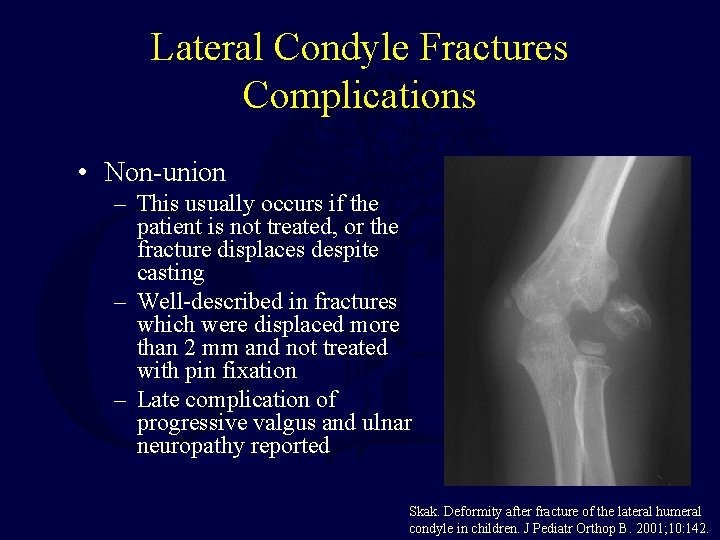 Lateral Condyle Fractures Complications • Non-union – This usually occurs if the patient is Lateral Condyle Fractures Complications • Non-union – This usually occurs if the patient is
