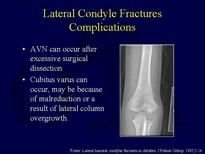 Lateral Condyle Fractures Complications • AVN can occur after excessive surgical dissection • Cubitus Lateral Condyle Fractures Complications • AVN can occur after excessive surgical dissection • Cubitus