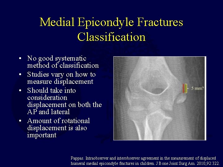 Medial Epicondyle Fractures Classification • No good systematic method of classification • Studies vary Medial Epicondyle Fractures Classification • No good systematic method of classification • Studies vary