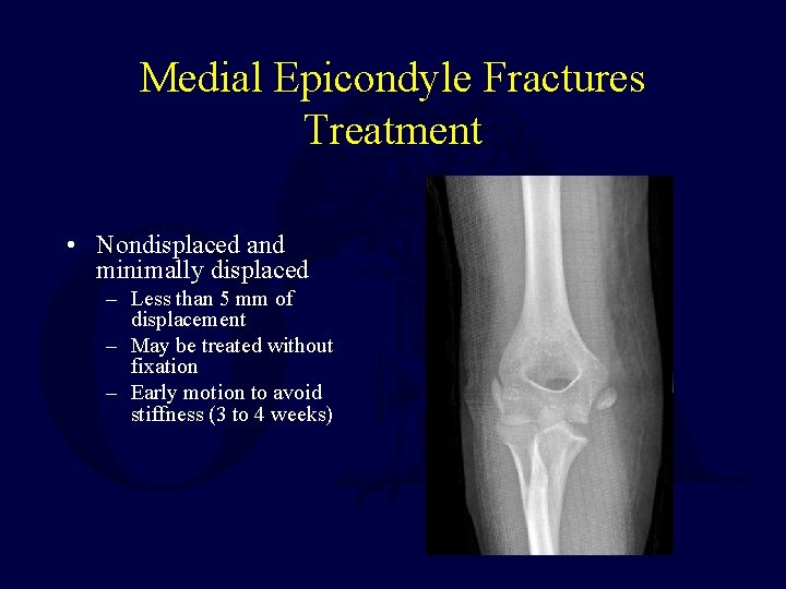 Medial Epicondyle Fractures Treatment • Nondisplaced and minimally displaced – Less than 5 mm Medial Epicondyle Fractures Treatment • Nondisplaced and minimally displaced – Less than 5 mm