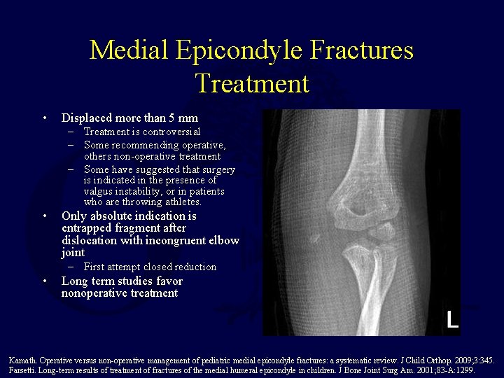 Medial Epicondyle Fractures Treatment • Displaced more than 5 mm – Treatment is controversial Medial Epicondyle Fractures Treatment • Displaced more than 5 mm – Treatment is controversial
