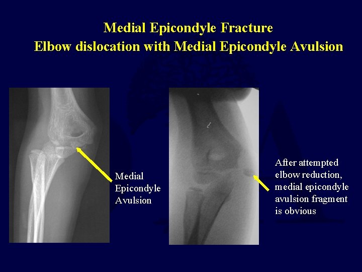 Medial Epicondyle Fracture Elbow dislocation with Medial Epicondyle Avulsion After attempted elbow reduction, medial Medial Epicondyle Fracture Elbow dislocation with Medial Epicondyle Avulsion After attempted elbow reduction, medial