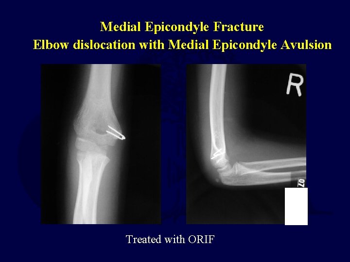 Medial Epicondyle Fracture Elbow dislocation with Medial Epicondyle Avulsion Treated with ORIF  Medial Epicondyle Fracture Elbow dislocation with Medial Epicondyle Avulsion Treated with ORIF