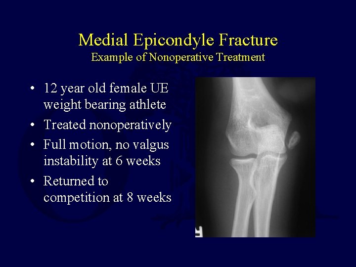 Medial Epicondyle Fracture Example of Nonoperative Treatment • 12 year old female UE weight Medial Epicondyle Fracture Example of Nonoperative Treatment • 12 year old female UE weight